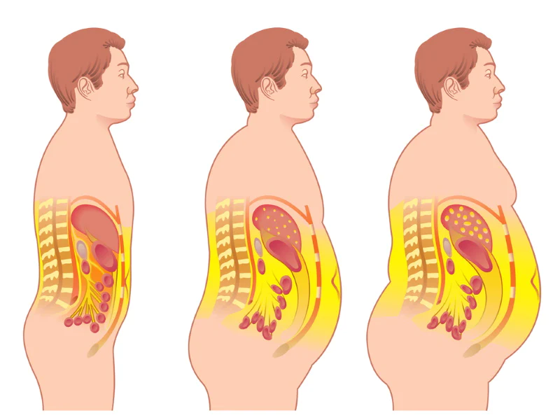 Obesità viscerale: cause e soluzioni